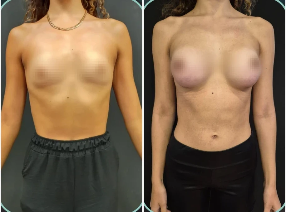 Antes e depois, Prótese de Mama